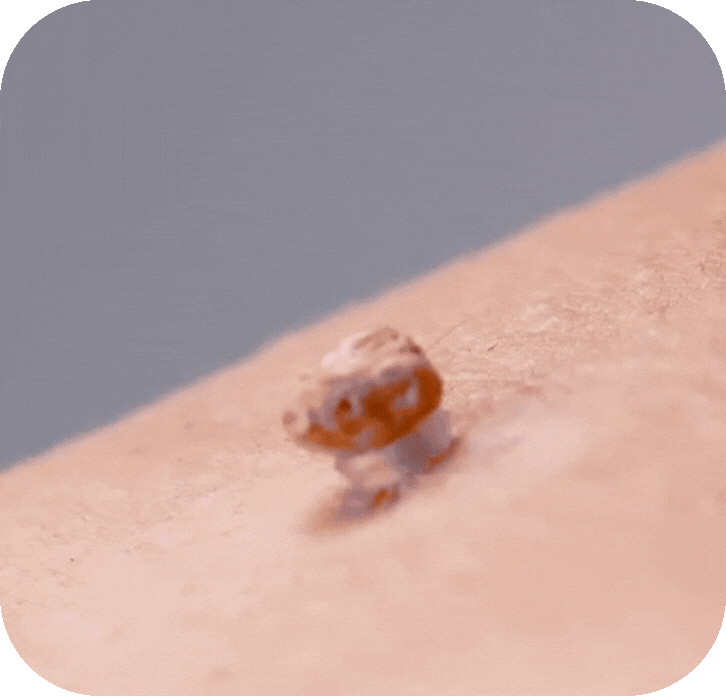 Hycare™ – Smärtfri hudflikborttagning