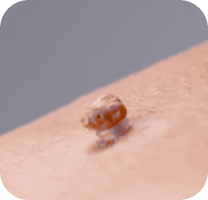 Hycare™ – Smärtfri hudflikborttagning